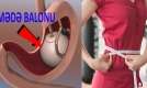 Əməliyyat olmadan 15 günə 10 kq arıqla –  Mədə balonu nədir, necə qoyulur? - ARAŞDIRMA-VİDEO