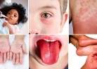 Uşaqlarda multisistemli iltihab sindromu   - İnfeksiiyalardan sonra baş qaldırır