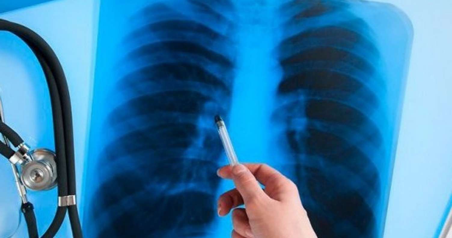 Azərbaycanda vərəm epidemiyası ola bilər   - 1 ildə 5000 nəfər yoluxub