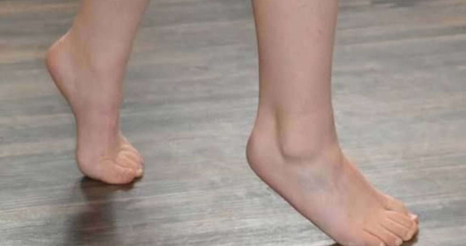 Uşaqların barmaq ucunda gəzməməai üçün bunları edin -  VİDEO