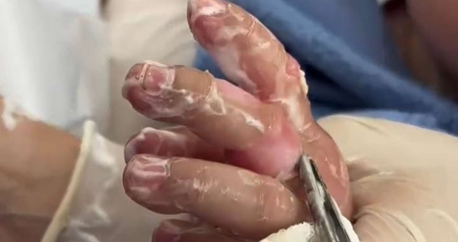 10 aylıq körpə yanıq xəsarəti aldı -  Əlini qaynar çaydana salıb... - VİDEO