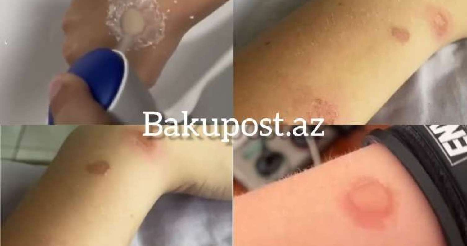 Gənclər özlərini yandırır – Sosial şəbəkələrdə qorxunc trend -  Deodorant Challenge - VİDEO