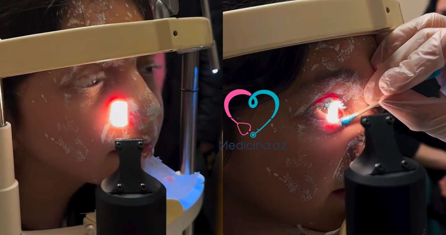 Şagirdin istifadə etdiyi ağardıcı partladı -  Gözü zədələndi - VİDEO