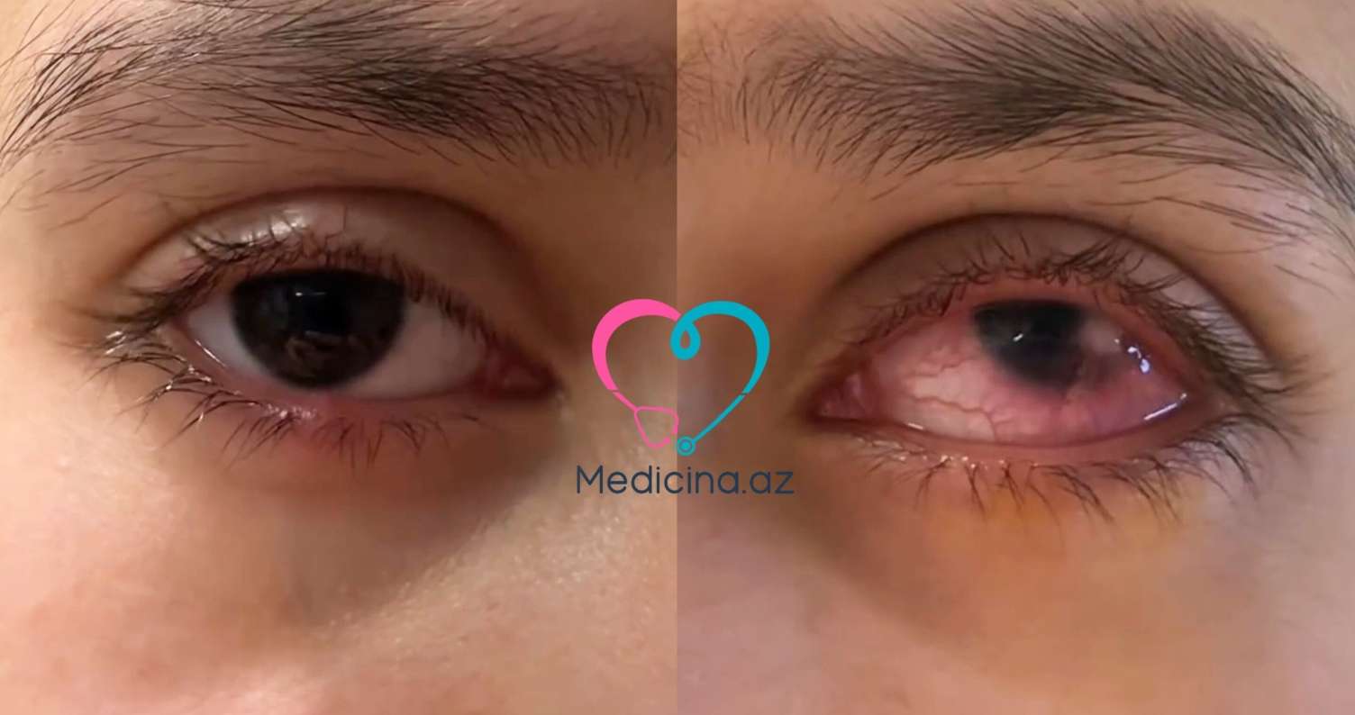 Çox şirniyyat yeyən uşağın gözü dəhşətli hala düşdü -  VİDEO