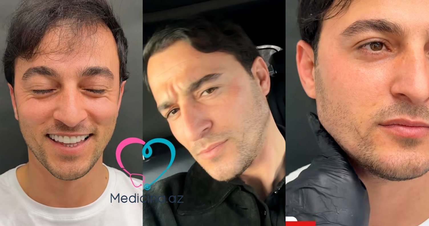 İqo üzünə estetik prosedur etdirdi -  VİDEO