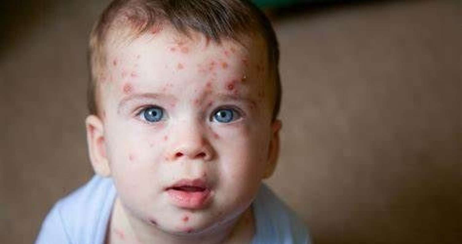 Uşaqlar arasında suçiçəyi xəstəliyi yayılıb -  VİDEO