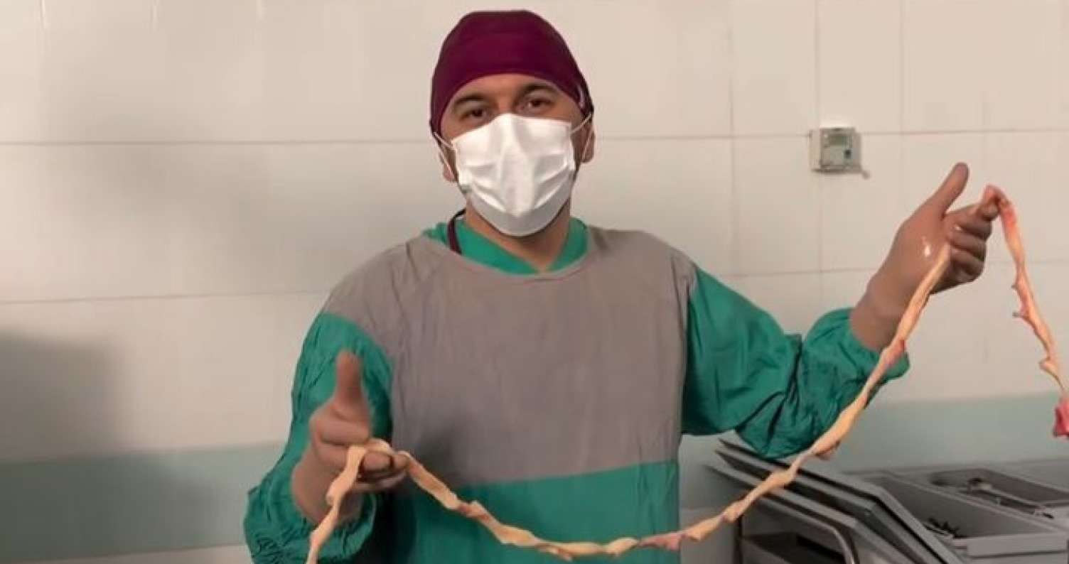 Qadından çıxarılan miomanın ölçüsü hər kəsi təəccübləndirdi -  VİDEO