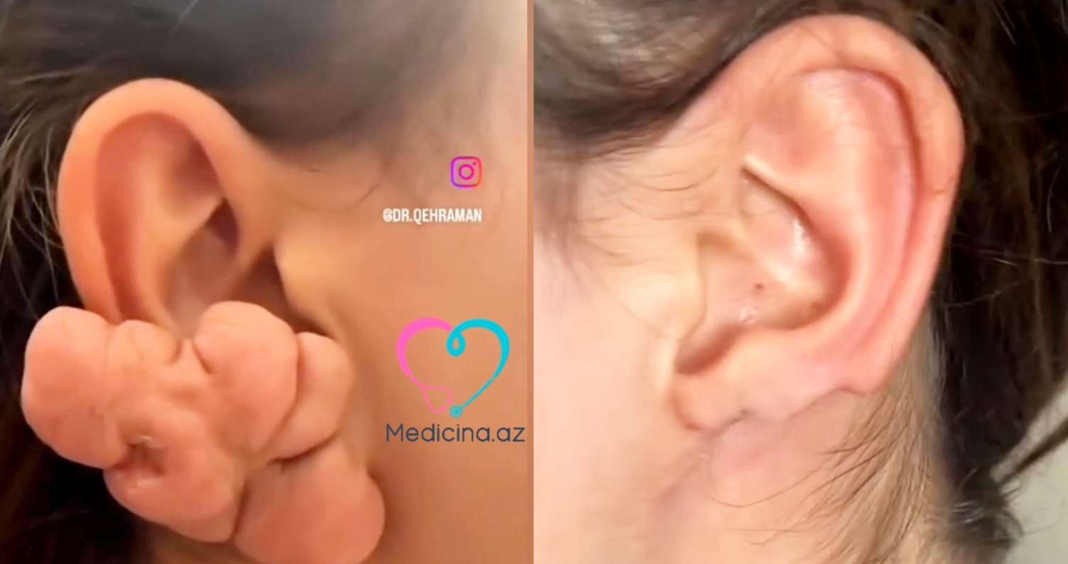 Sırğadan sonra qulağı bu hala düşdü -  VİDEO