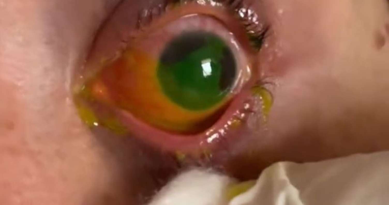 Gözünə potaş məhlulu töküldü, yandı -  VİDEO