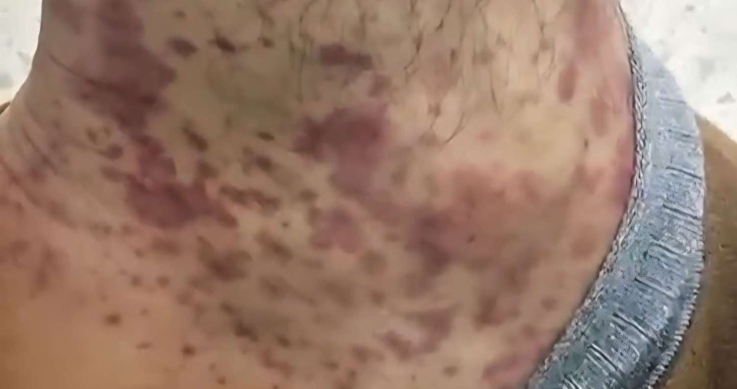 Qan durulaşdırıcı dərmanlardan ayağı bu hala düşdü -  VİDEO