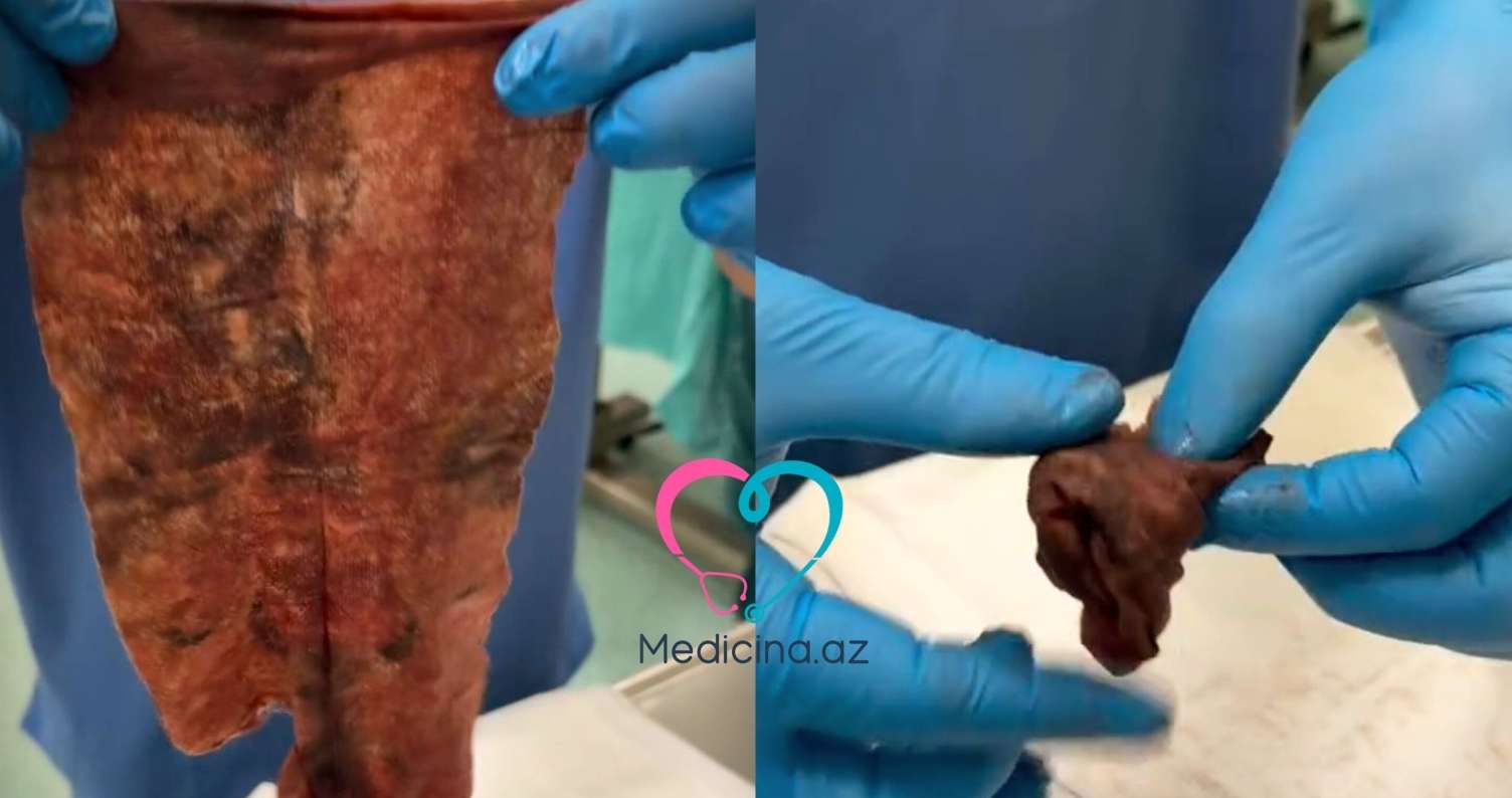 Vaginaya salfet qoyan qadın ağır infeksiyaya yoluxdu -  VİDEO