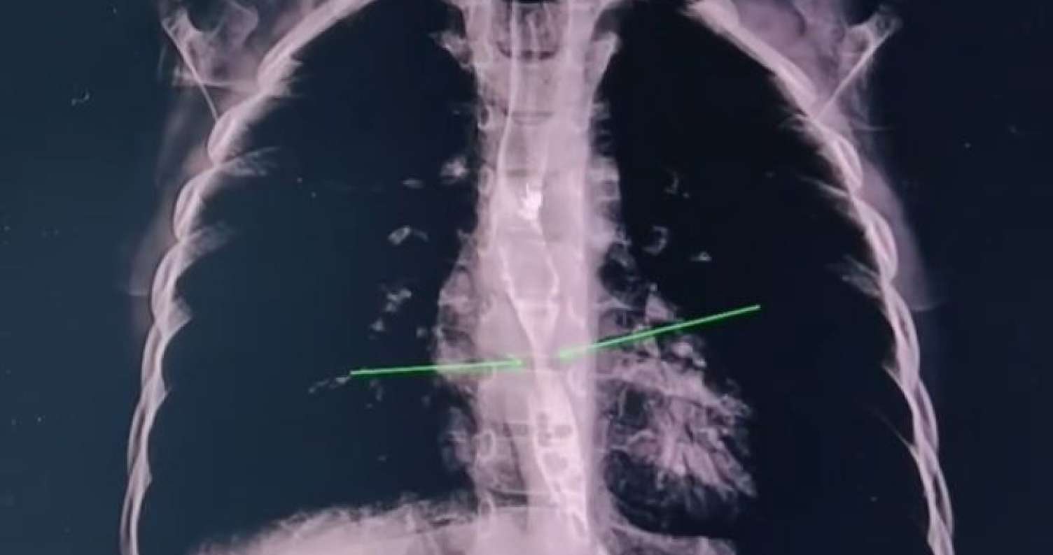 2 yaşlı uşaq yağ çözücü içdi - Daxili orqanları yandı -  VİDEO