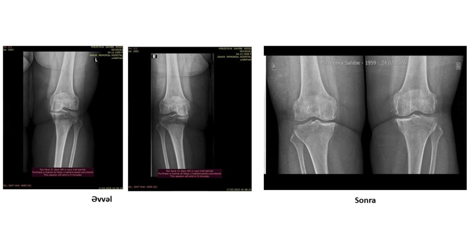 Protez təklif edildi, amma əməliyyatsız sağaldı –  Real pasiyent hekayəsi-VİDEO