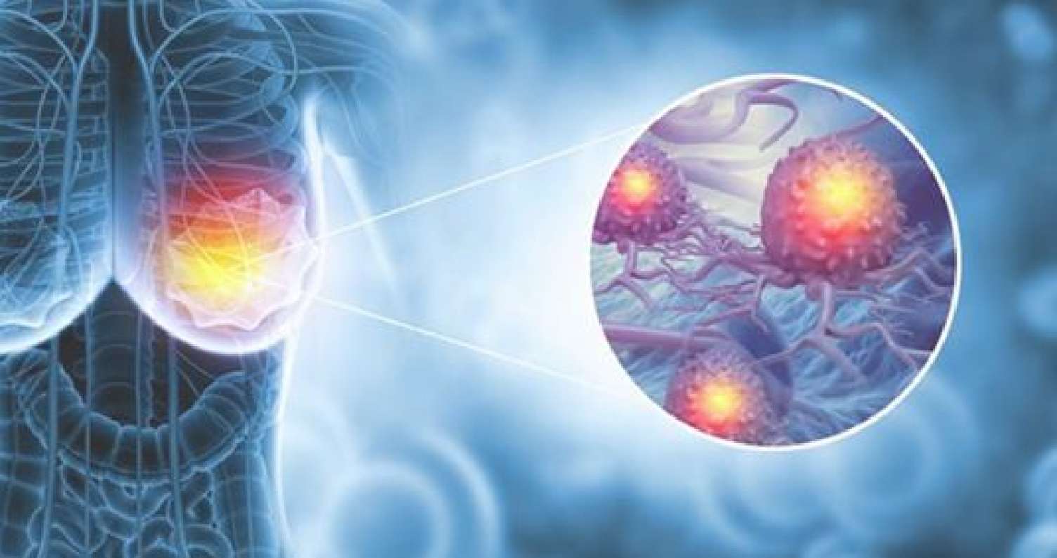 Mamoqrafiya “təmiz” olsa da, xərçəng necə aşkarlandı? -  Real pasiyent hekayəsi-VİDEO