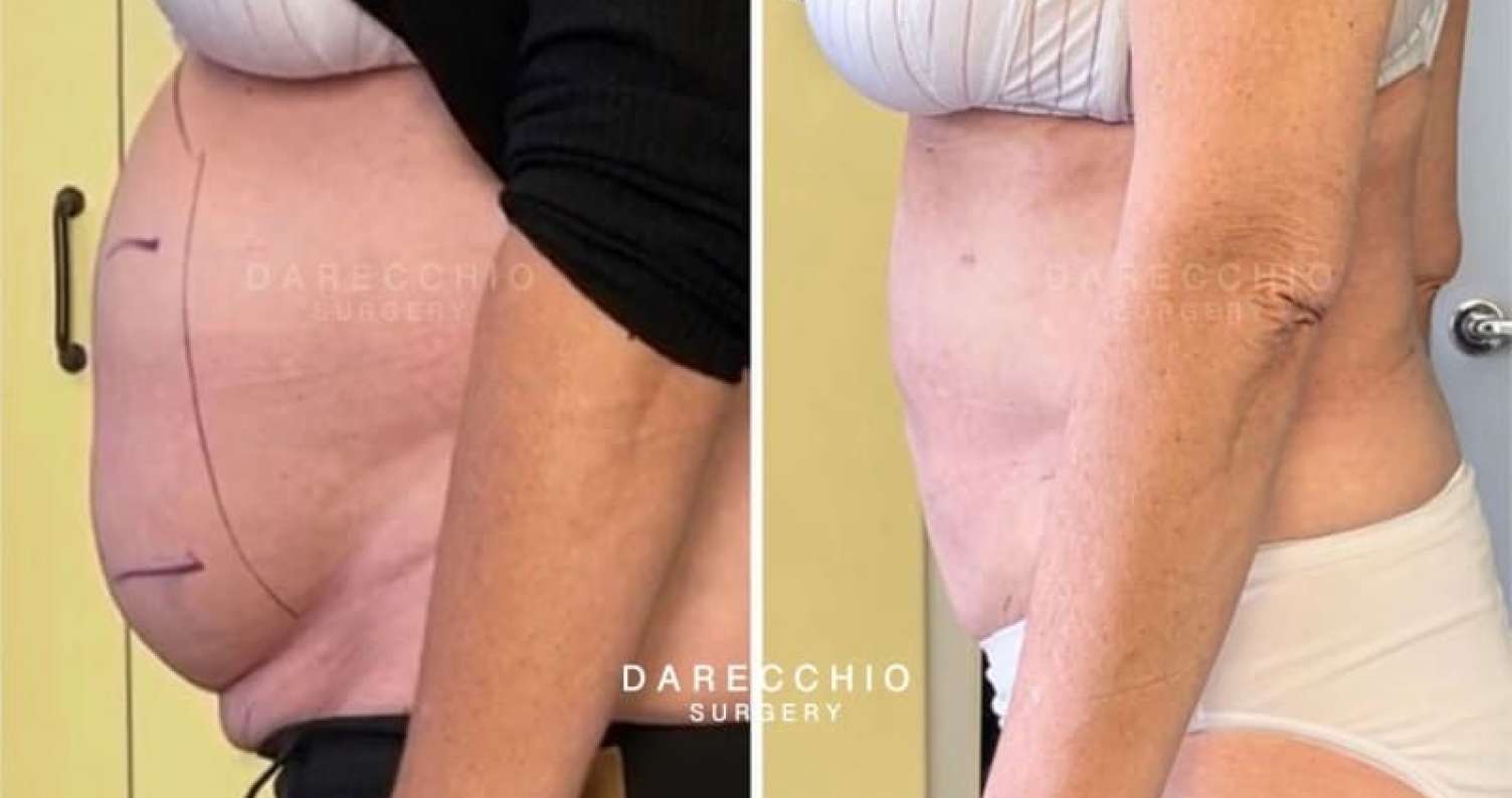  Qadının qarnı önə doğru çıxırsa... -   Səbəbləri - VİDEO