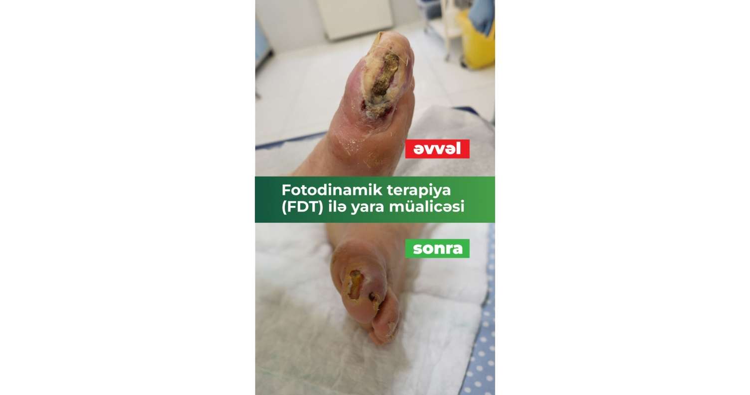 Ayağı kəsilməkdən xilas edən müalicə:  Fotodinamik terapiya (FDT) ilə diabetik yaralarda sürətli sağalma - VİDEO