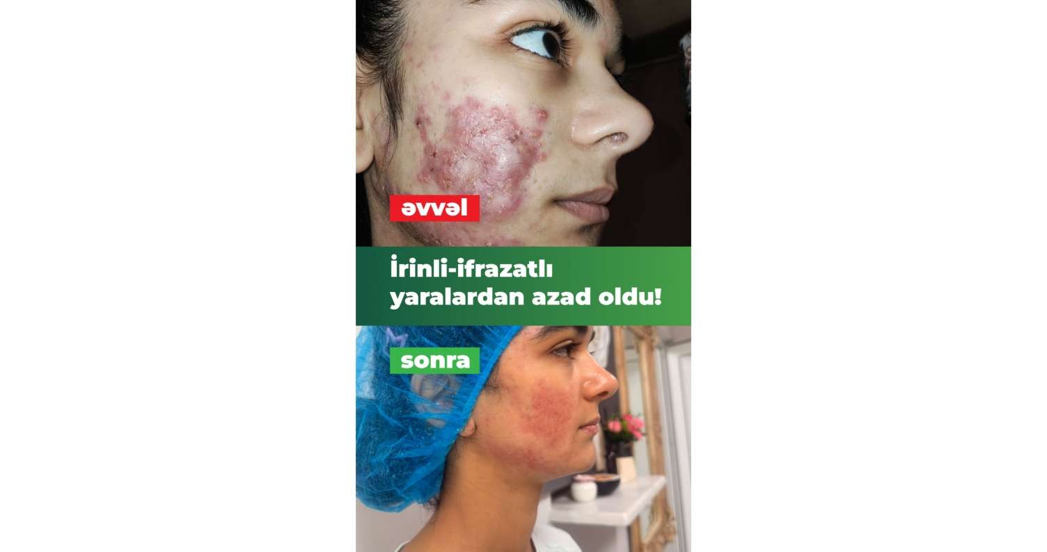 İltihablı sızanaqlar yeniyetmənin həyatını alt-üst etmişdi.  İnteqrativ müalicə ilə həll yolu tapıldı - VİDEO