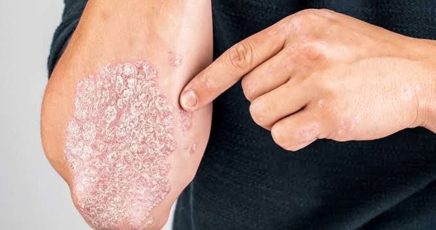 Psoriaz niyə təkrarlanır? -  Mütəxəssis səbəbləri açıqladı - VİDEO