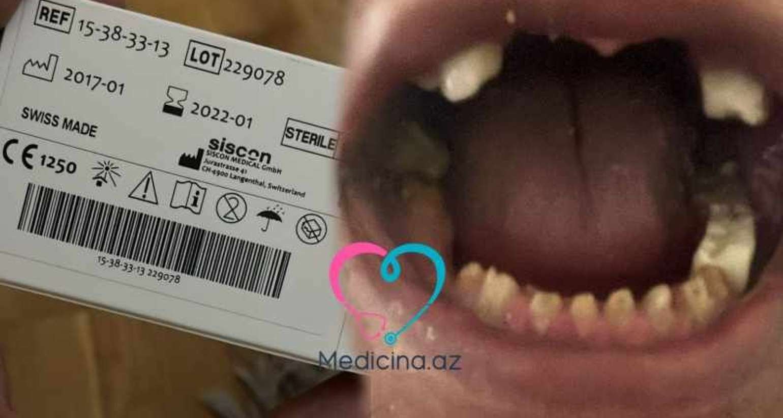  Həm dişlərini itirdi, həm də 8700 manatını  – Stomatoloq pasiyenti fəlakətə sürüklədi