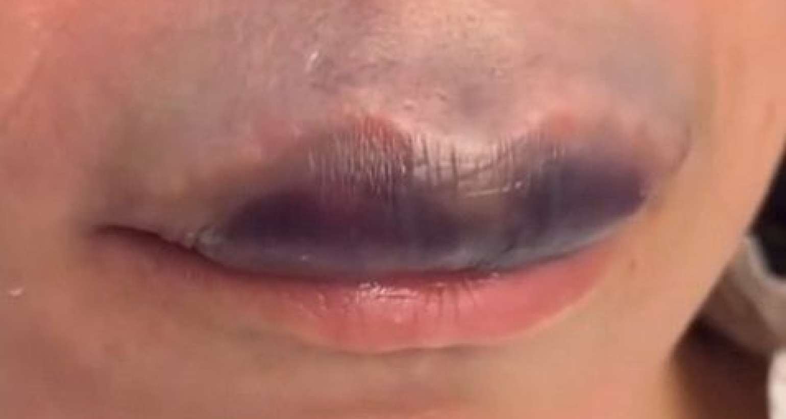 Daha bir qadın estetik qurbanı oldu -  VİDEO