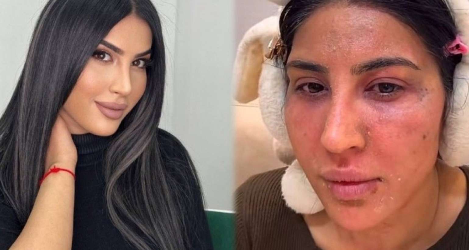 Reklam etdiyi pilinq  Ləmanın üzünü yandırdı