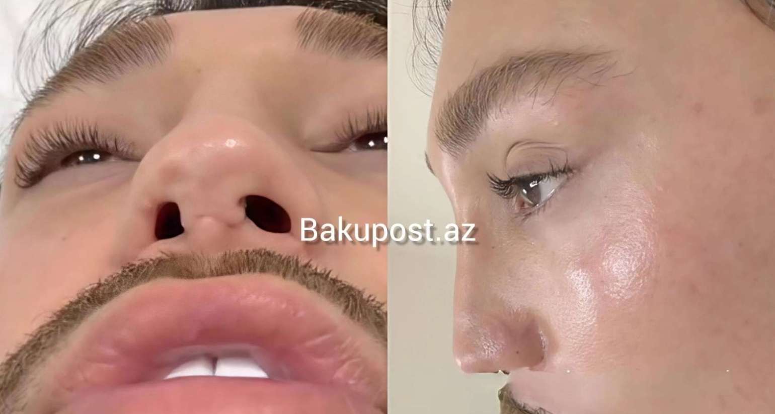 4 dəfə uğursuz əməliyyat etdirən stilist   - Həkimləri ifşa etdi - Adlar