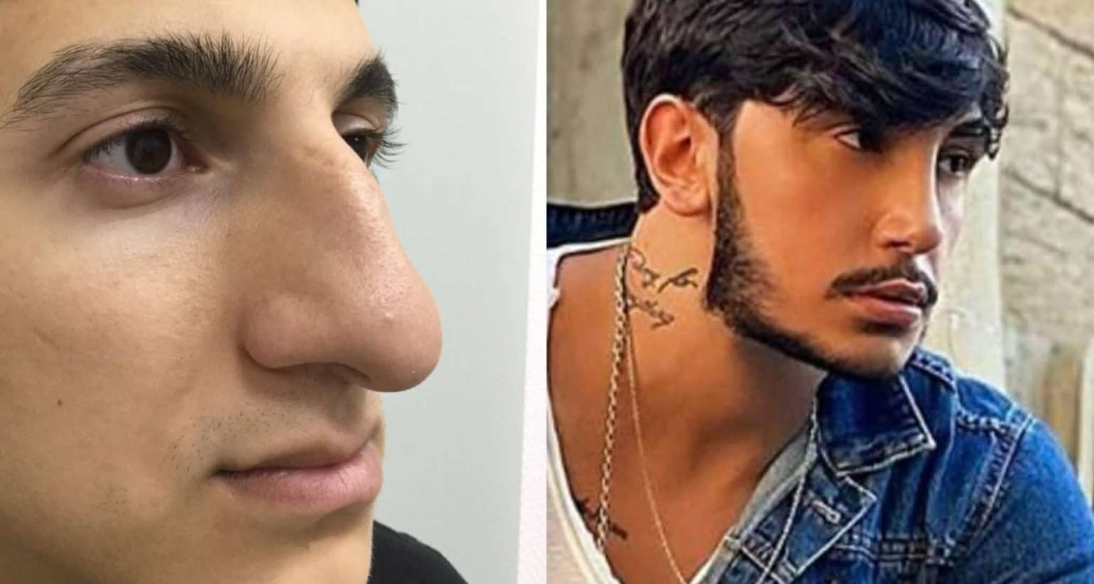 LOR cərrah stilistin yalanını üzə çıxardı  -  Əvvəlki burnu ilə müqayisə edin - FOTOFAKT