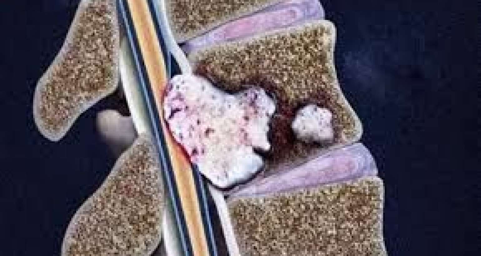 Xərçəngin metastaz verdiyini göstərən    - 5 Əlamət