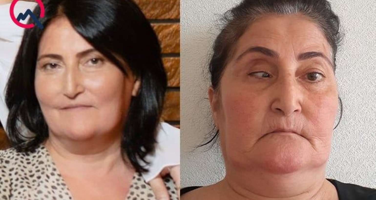 Bu klinika təzminat ödəyəcək -  Burun düzəldəndə gözü zədələyib
