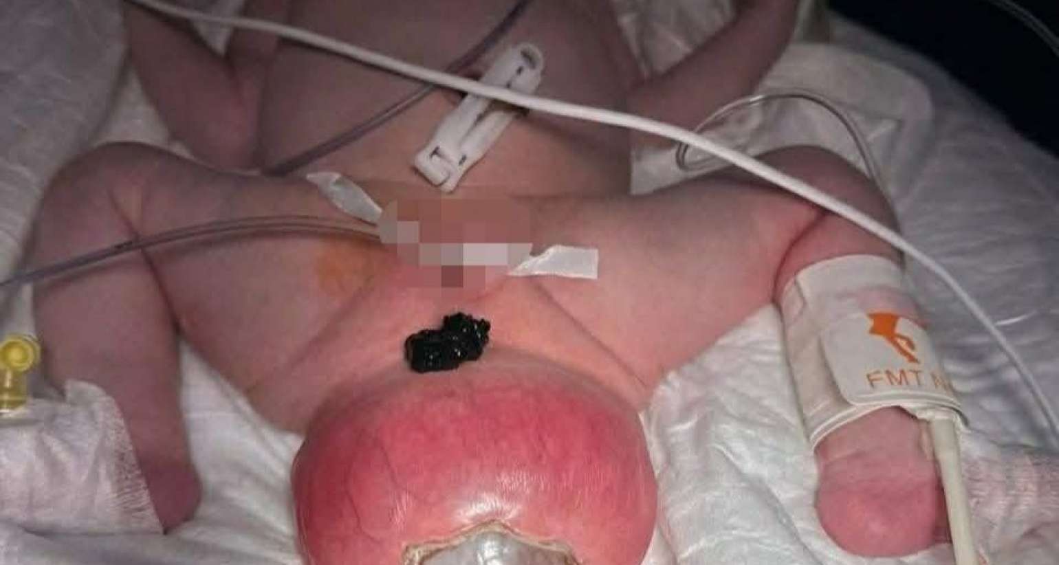 Bakıda büzdüm nahiyəsində nəhəng şiş olan körpə  əməliyyat edildi - FOTO