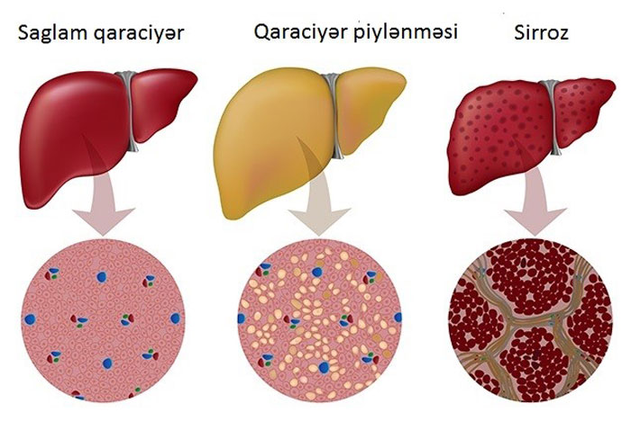  Bakıda unikal müayinə-müalicə metodları ARTIQ "HEPATİT C"  6 AYA TAM SAĞALDILIR -