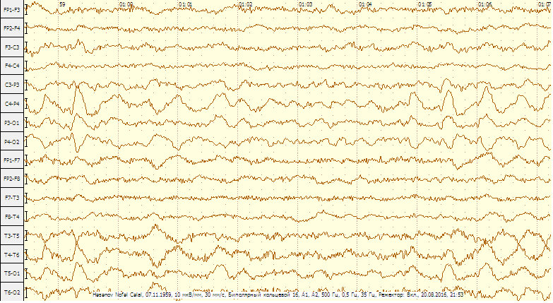  Epilepsiya ilə bağlı faydalı yazı -  Nevroloqumuz başının üstündən maşın keçən xəstəni necə xilas edib... 