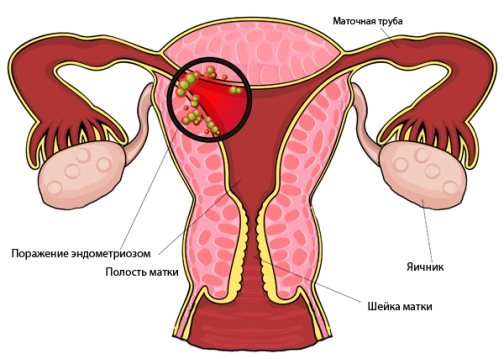 Endometrioz qadınların “baş bəlası” –  Sonsuzluğun səbəbidir