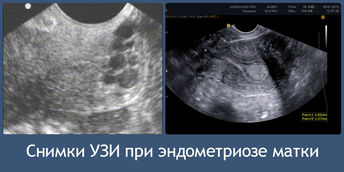 Endometrioz qadınların “baş bəlası” –  Sonsuzluğun səbəbidir