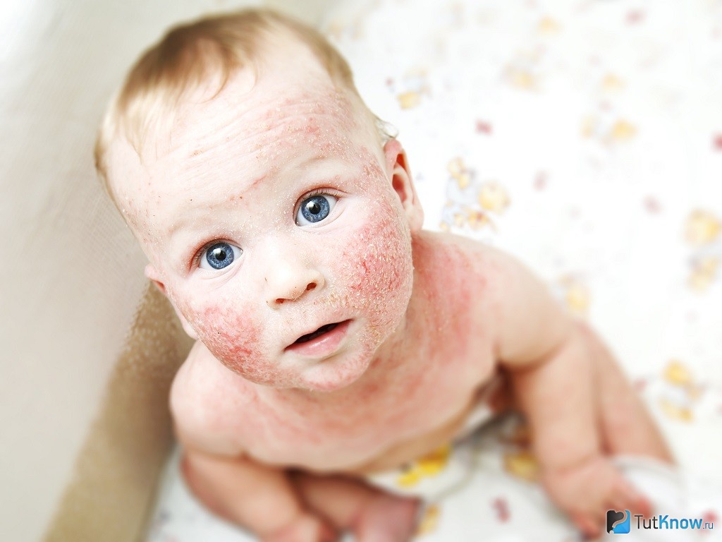 Uşaqlarda allergik dermatit –  Əsrin bəlası