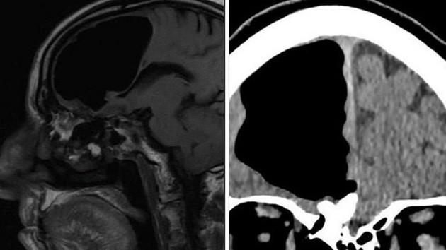 Baş ağrısı ilə həkimə getdi -  Beyni olmadığı ortaya çıxdı