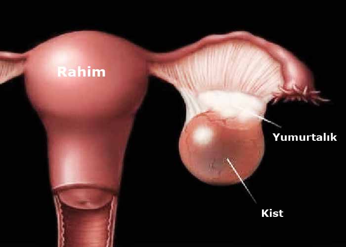 Çox ağrılı menstruasiyanın səbəbi... –  Şokolad şişi xəstəliyi nədir? 