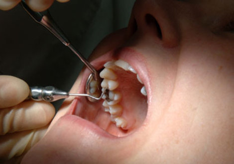 Xarab dişlər xroniki iltihab yaradır -  Araşdırma