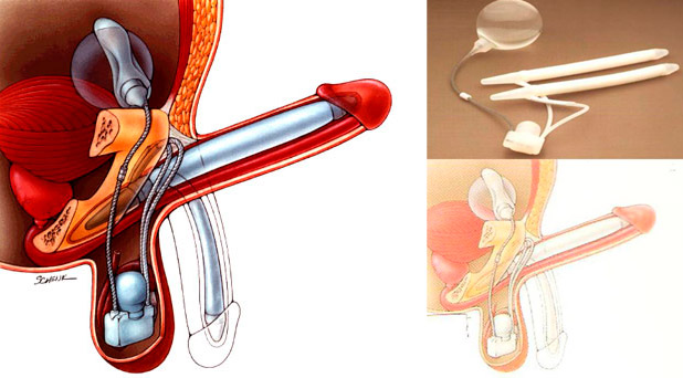 Cinsi zəiflik və erektil disfunksiyası olanlara penil implant–  Özünüzü 20 yaşındakı kimi hiss edəcəksiz