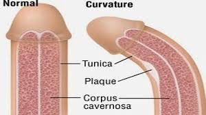 Kişilərdə penis əyriliyinin müalicəsi varmı -  Kişilərin gizlətdiyi sirr: PEYRONİYE 