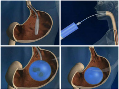 Mədəsinə ballon qoyanlar arasında ölüm halları artır -  FDA xəbərdarlıq etdi