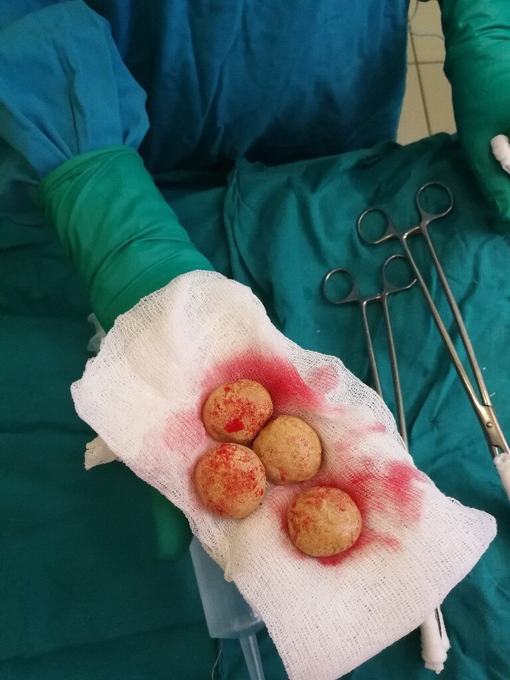 Kişinin sidik kisəsindən nəhəng daşlar çıxarıldı –   Yumurta boyda daşlardan yuva yaranmışdı