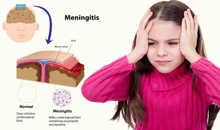 Uşaqda meningit olduğunu necə bilməli –  Uşaqları qəfil öldürən infeksiya