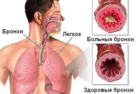 Bronxit astmaya çevrilə bilər, vaxtında müalicə olunun -  Məşhur həkim pulmonoloqdan xəbərdarlıq