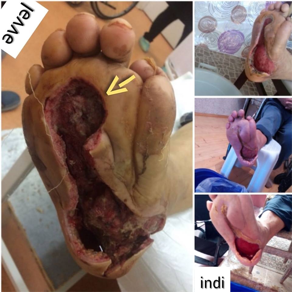Azərbaycanda diabetik ayaq kabinetləri niyə yoxdur?  -   Ayaqdakı yaralar əlilliyə aparır- ARAŞDIRMA