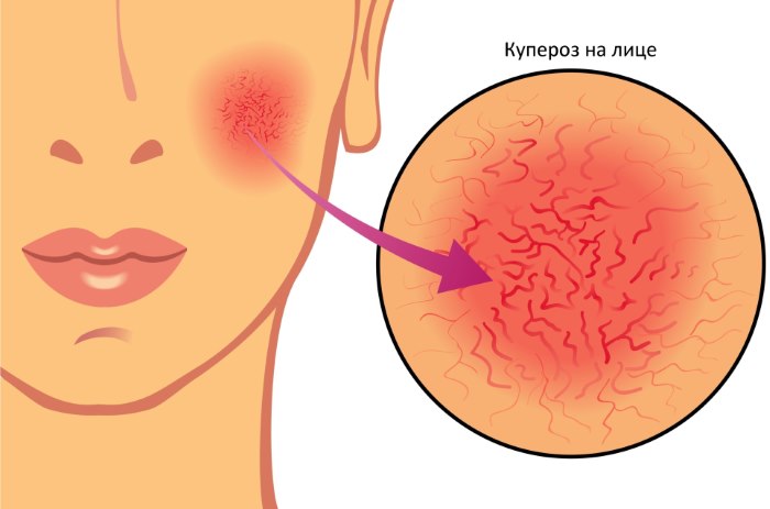 Kuperoz –üzdəki ulduzcuqlar –  Səbəbləri, müalicəsi