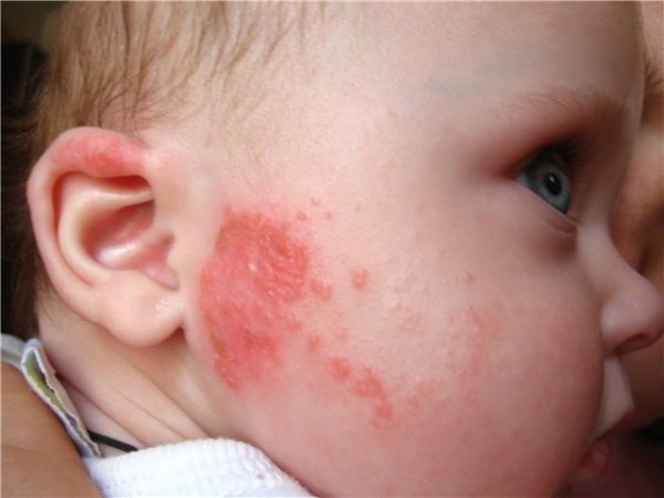 Uşaqlarda allergiyanın səbəbləri və düzgün müalicəsi –  Həkimdən VİDEO ÇIXIŞ