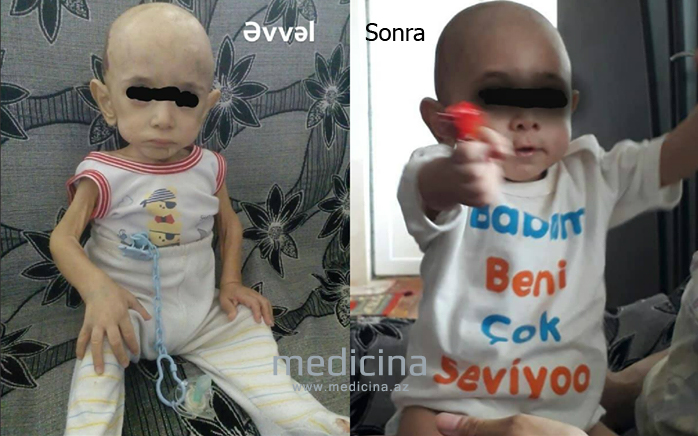 Həkimlərin “aparın, öləcək” dedikləri körpənin xilası üçün inanılmaz addım –  Azərbaycanda pediatrdan möcüzə/ FOTO