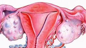 Subay qızlarda da rast gəlinən yumurtalıqların kistləri –  Müalicə, yoxsa əməliyyat?
