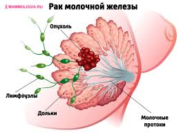 Süd vəzi xərçənginin əlamətləri, səbəbi, müalicəsi – PULSUZ HƏKİM MÜAYİNƏSİ